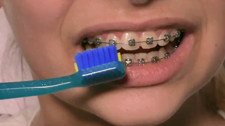 Уход за брекетами. Как чистить брекеты? Щётка Curaprox Ortho.
