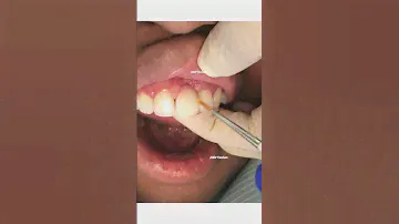 Dental bridge procedure | front tooth bridge | dental bridge before and after | Dr. Yazdan