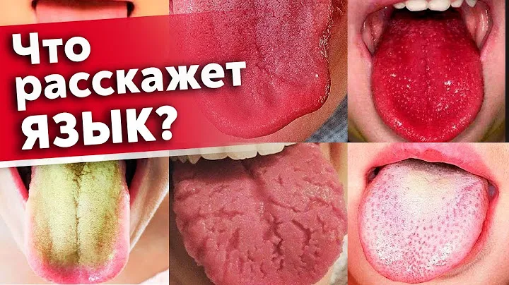 Язык предупредит вас о болезнях! | Как диагностировать состояние организма по языку?