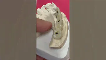 5-Unit Pontic Bridge Implant