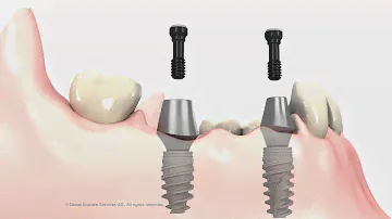 3 unit Bridge on implant abutments